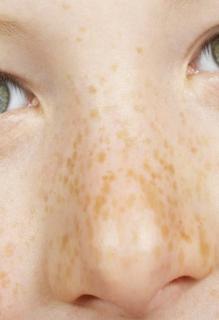 <p>Why do foods taste bland when you have a blocked nose?<span data-tex=""> </span></p>