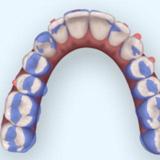 下面图示的患者矫治难度属于（）难度