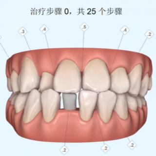 图示患者的矫治难度属于（）难度