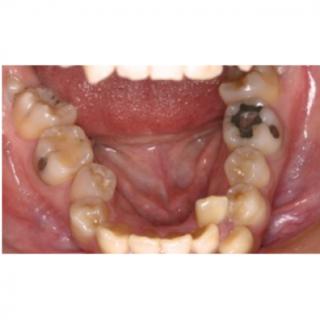 图示患者的矫治难度属于（）难度