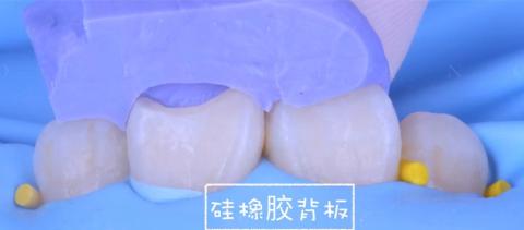 <p>当补门牙时，硅橡胶背板的作用是什么？</p>