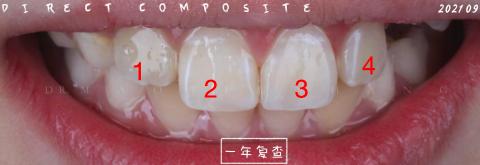 <p>请问图片上哪颗牙齿补过牙？</p>