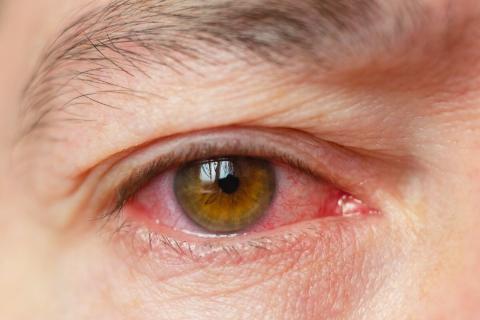 <p>His wound had to be carefully treated to avoid any ________ infections that could have resulted in further complications.</p>