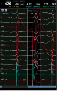 <p>根据室早图形，选出最有可能起源的位置</p>