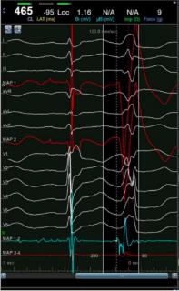 <p>根据室早图形，选出最有可能起源的室早位置</p>