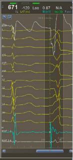 <p>根据室早图形，选出最有可能的室早起源位置</p>