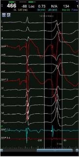 <p>根据室早图形，选出最有可能的起源位置</p>