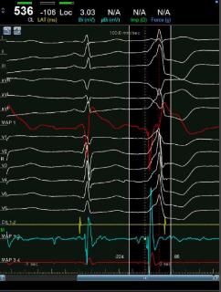 <p>根据室早图形，选择最有可能起源的位置</p>