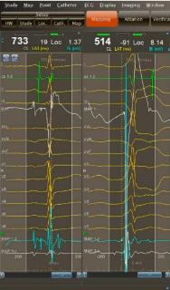<p>根据室早图形，选择最有可能的室早起源位置</p>
