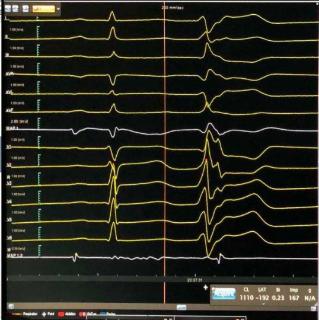 <p>根据室早图形，选择最有可能的室早起源位置</p>