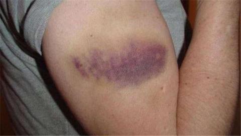 <p>用一个词描述这个人胳膊上的状况&#xff1f;</p>