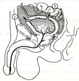<p>图中2为腹膜内型</p>