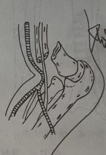 <p>是哪一种类型骨折？</p>