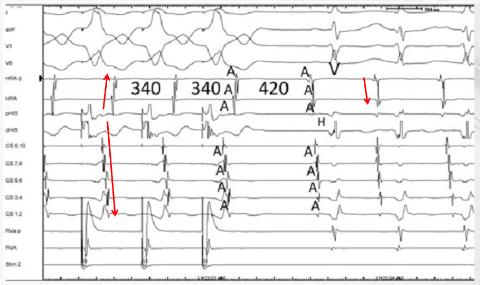 <p>图中VOP中出现的现象可诊断该心动过速为？</p>