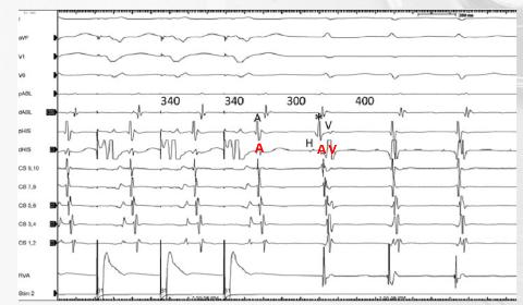 <p>根据图中VOP停止以后的反应，可推测该心动过速为？</p>