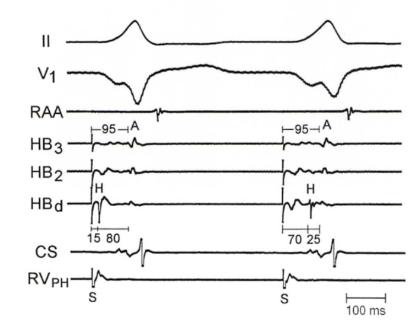 <p>对于图片中Para His pacing的过程，描述正确的是？（多选）</p>