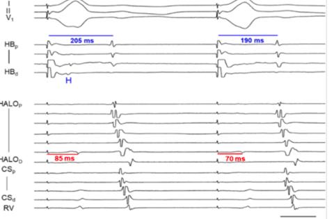 <p>关于图片中 para his pacing的过程，描述正确的是（多选）</p>