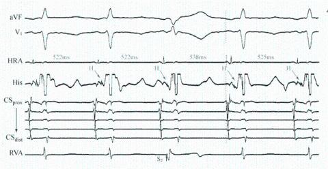 <p>图中电生理现象，提示该心动过速为？</p>