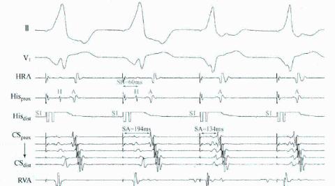 <p>根据图片中para his pacing现象，可基本排除哪类心律失常？</p>