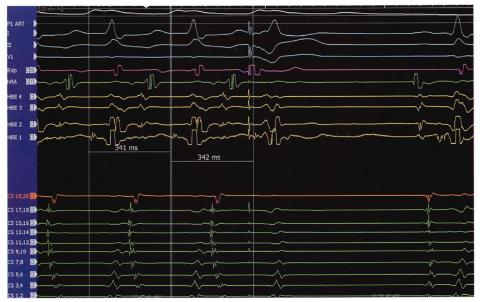 <p>图中提示哪类心律失常</p>