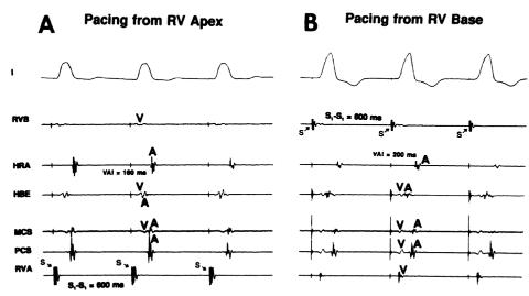 <p>图片中的起搏，提示逆传路径为？</p>