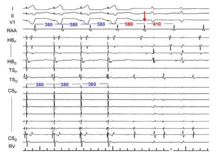 <p>关于图中电生理检查的过程描述正确的是？</p>