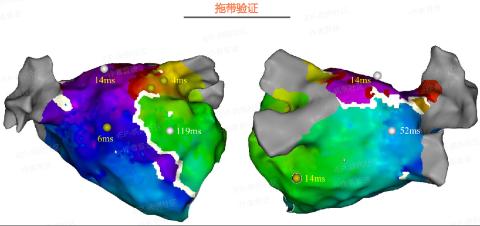 <p>根据激动图及拖带结果判断最有可能的折返机制</p>