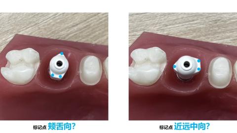 <p>种植扫描，扫描杆的标记点应该朝什么方向摆放？</p>