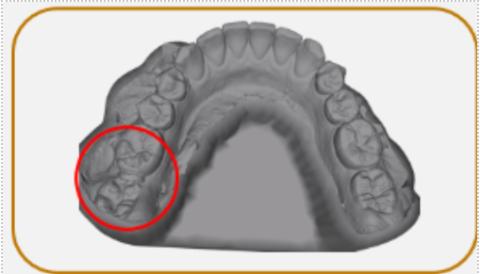 <p>以下模型存在正畸分牙圈是否需要送CCSR</p>