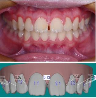 <p>（多选）请审阅牙齿1.1,2.1间隙修整存在什么问题？</p>