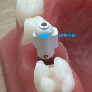 <p>如图，种植扫描杆除了蓝色区域有缺失外，其他部分均采集完整，不影响义齿制作？</p>