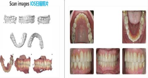 <p>Ios的扫描照片可用于评估咬合吗？</p>