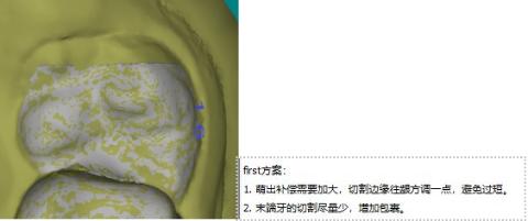 <p>以下方案切牙是否正确 ？</p>