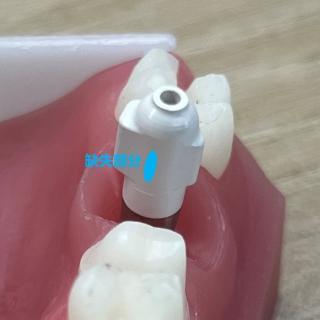 <p>如图，种植扫描杆除了近中有部分缺失外，其他部分均采集完整，不影响义齿制作？</p>