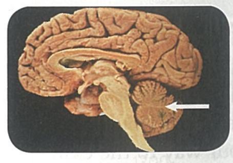 <p>If the portion indicated by the arrow was damaged as a result of trauma, what effect would this person most likely experience?</p>