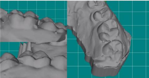 <p>该模型26远中多余材料，是否需要送ACO  ？</p>
